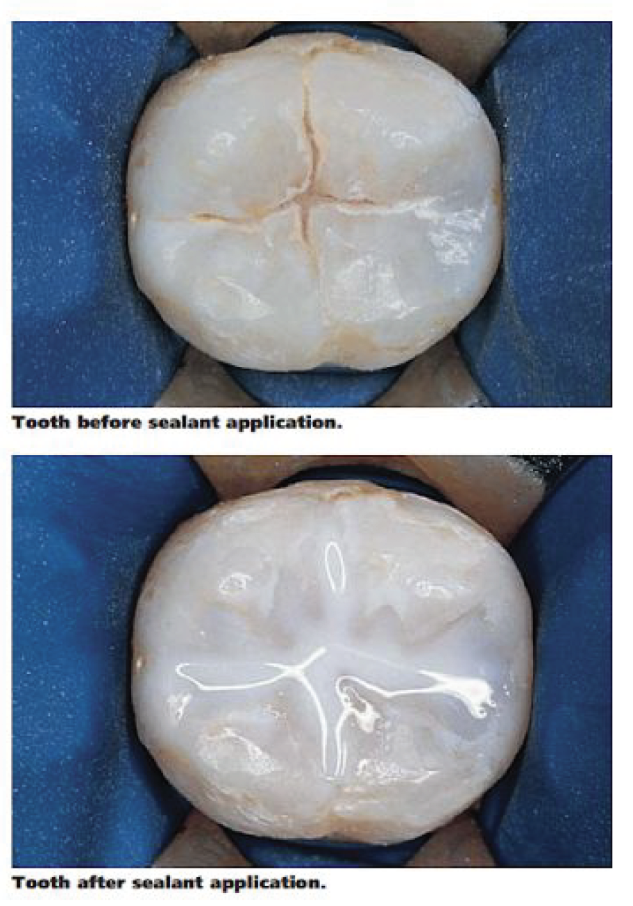 What are fissure sealants and why should my child have them? Kiddies