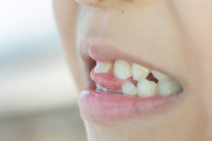 What To Do About That Wobbly Loose Tooth Kiddies Dental Care