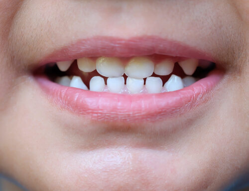 Teeth Grinding Is It A Problem Kiddies Dental Care